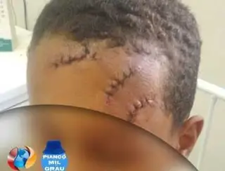 Criança de 8 anos é agredida com golpes de foice, em Piancó