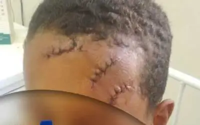 Criança de 8 anos é agredida com golpes de foice, em Piancó