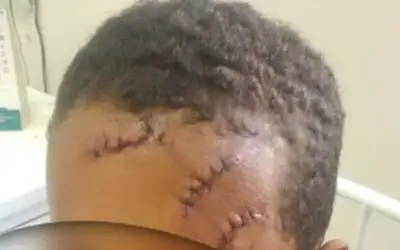 VÍDEO: Criança de 8 anos é atingida com golpe de foice no rosto na cidade de Piancó