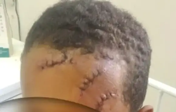 VÍDEO: Criança de 8 anos é atingida com golpe de foice no rosto na cidade de Piancó